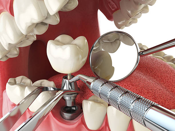 Best Root Canal Emergency Dentist  in Tice, FL